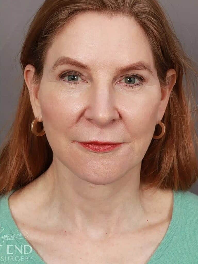 Brow Lift Before & After