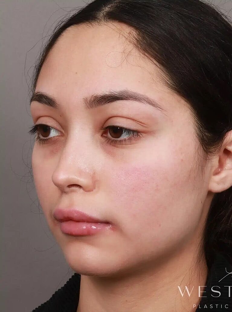 Brow Lift Before & After