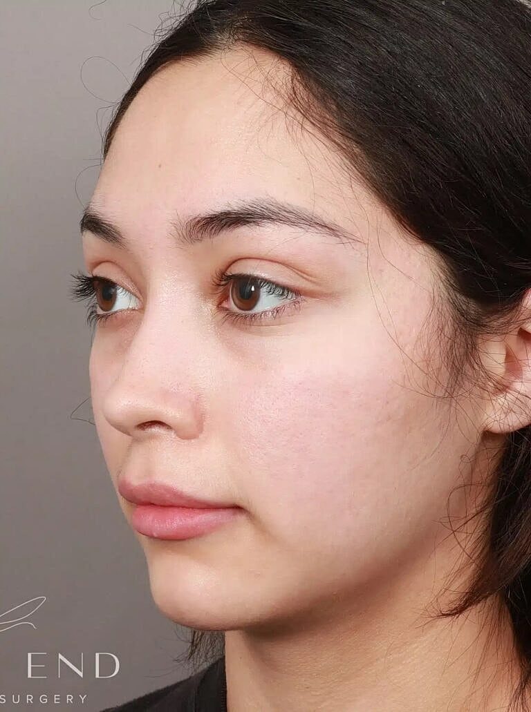 Brow Lift Before & After