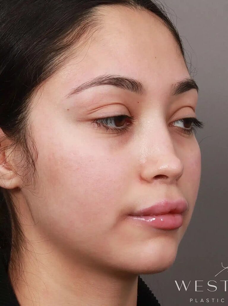 Brow Lift Before & After