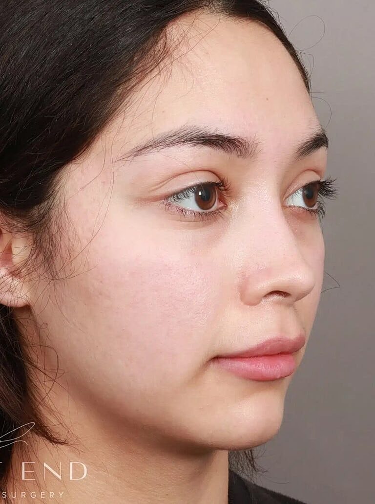 Brow Lift Before & After