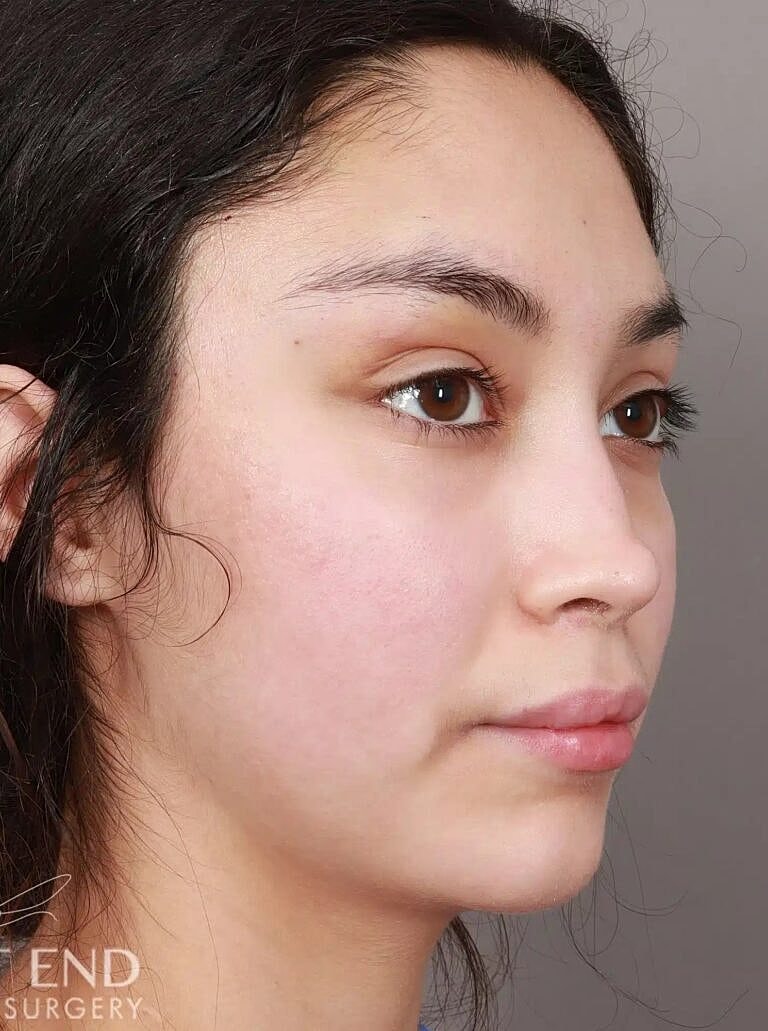 Brow Lift Before & After