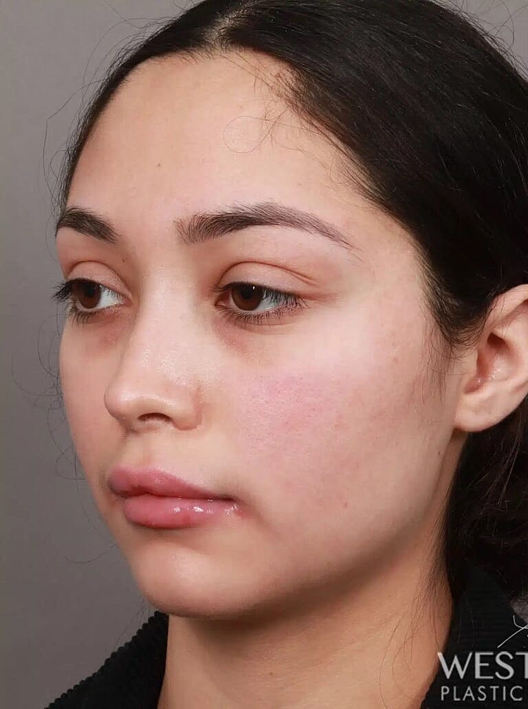 Brow Lift Before & After