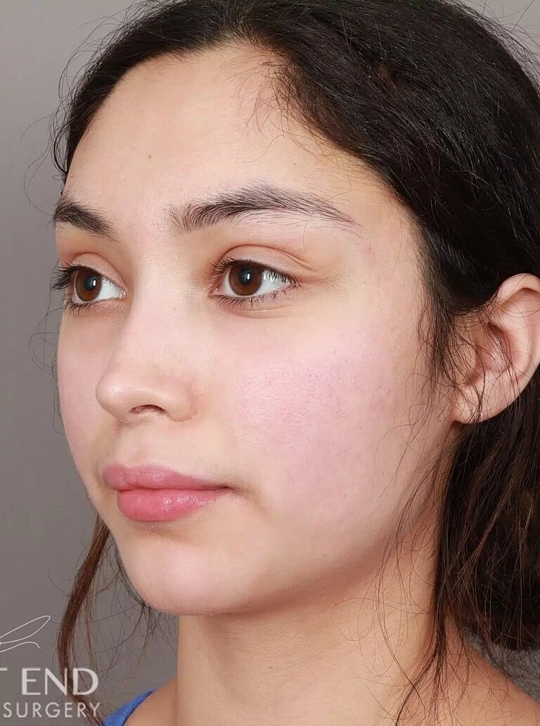 Brow Lift Before & After