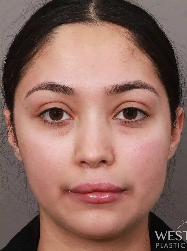 Brow Lift Before & After
