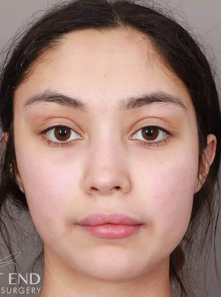 Brow Lift Before & After