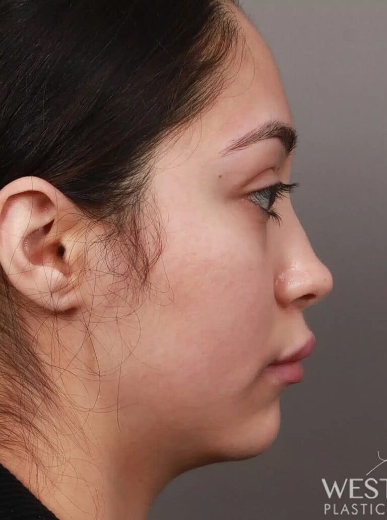 Brow Lift Before & After