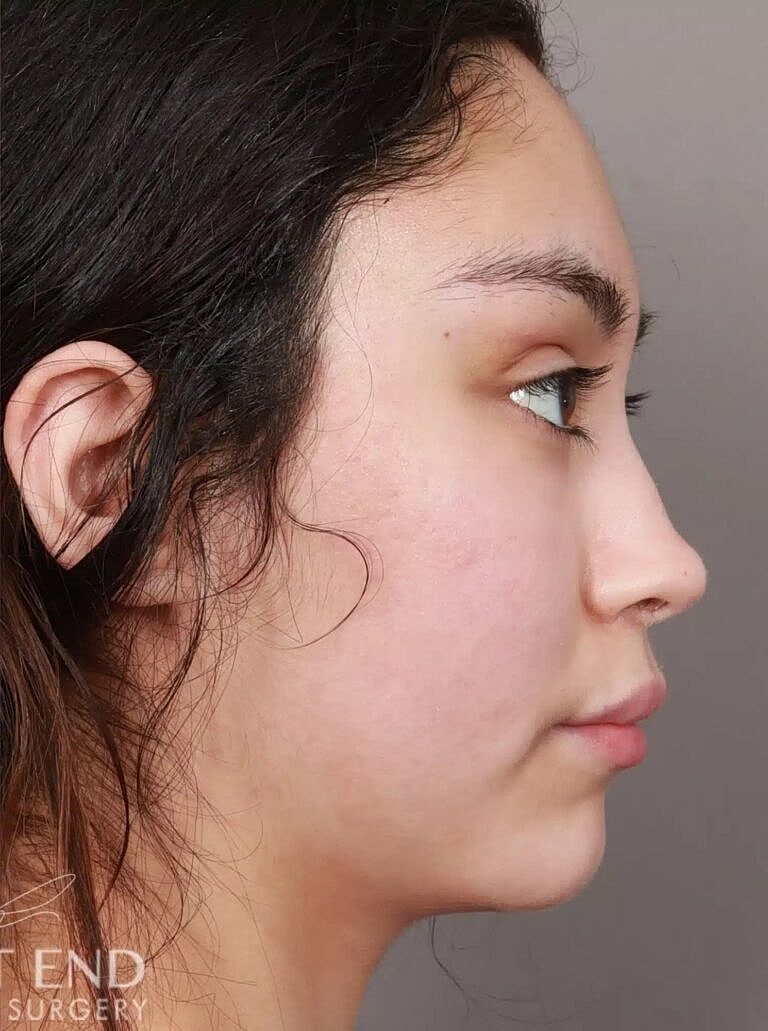 Brow Lift Before & After