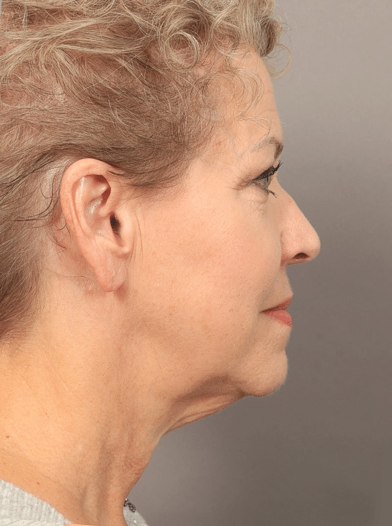 Brow Lift Before & After