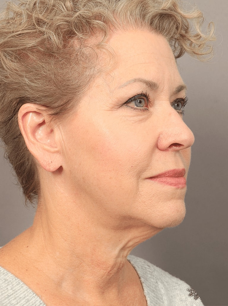 Brow Lift Before & After