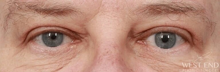 Brow Lift Before & After