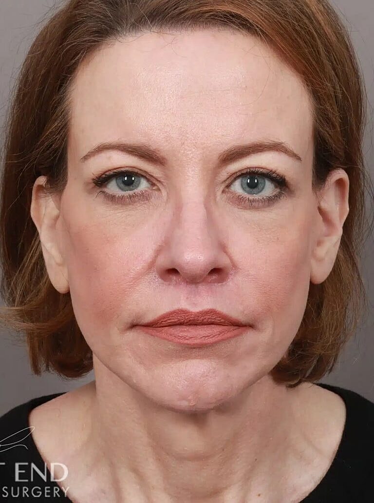 Brow Lift Before & After