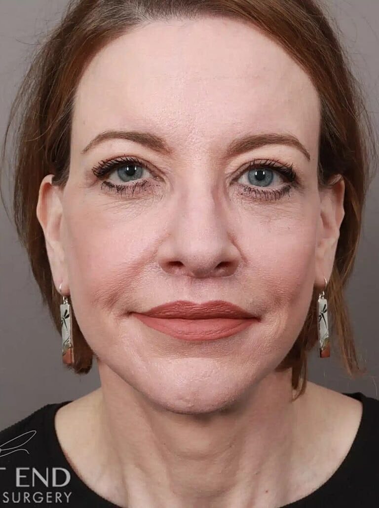 Brow Lift Before & After