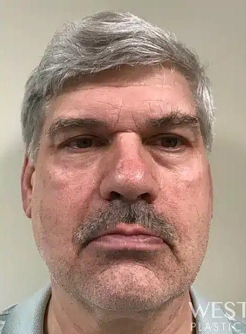 Brow Lift Before & After