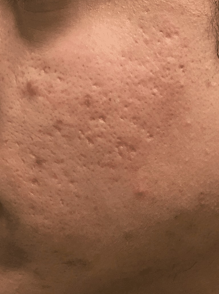 Chemical Peels Before & After