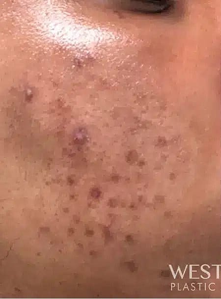 Chemical Peels Before & After