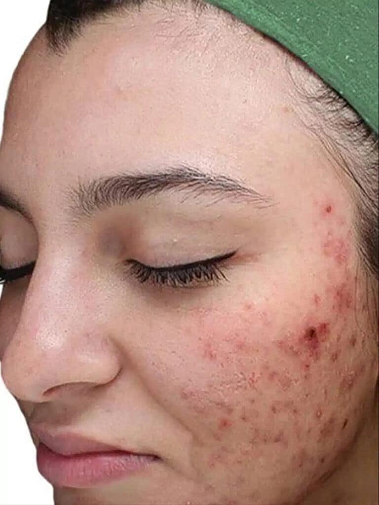 Chemical Peels Before & After