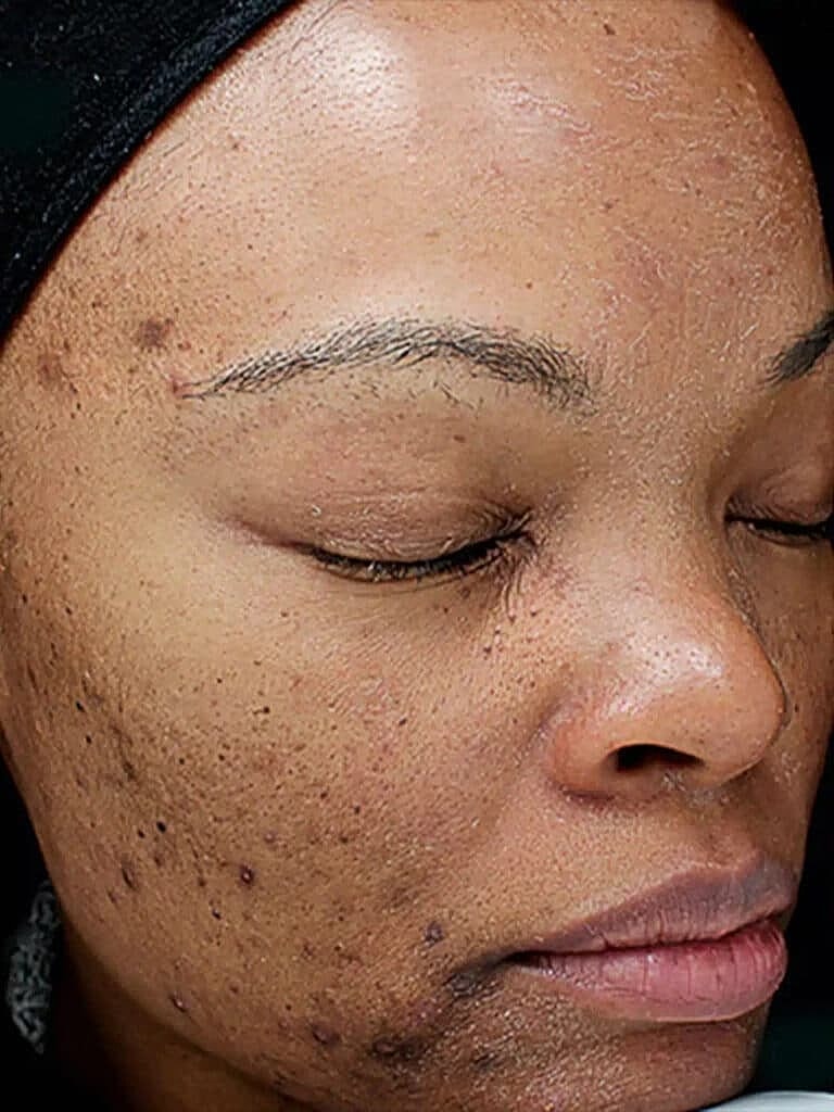 Chemical Peels Before & After