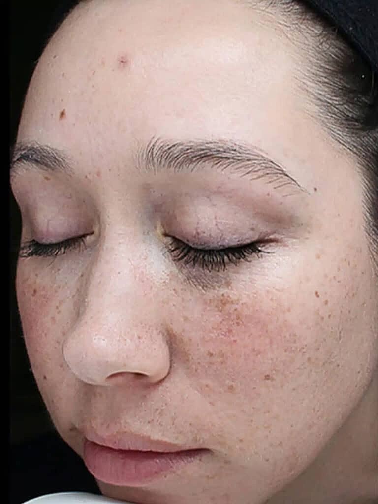 Chemical Peels Before & After