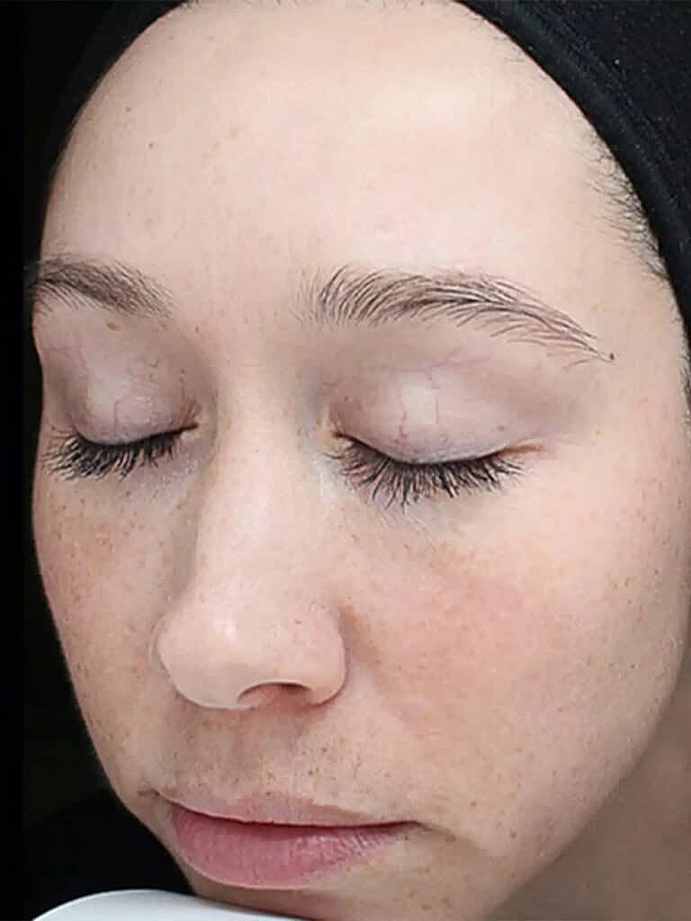 Chemical Peels Before & After