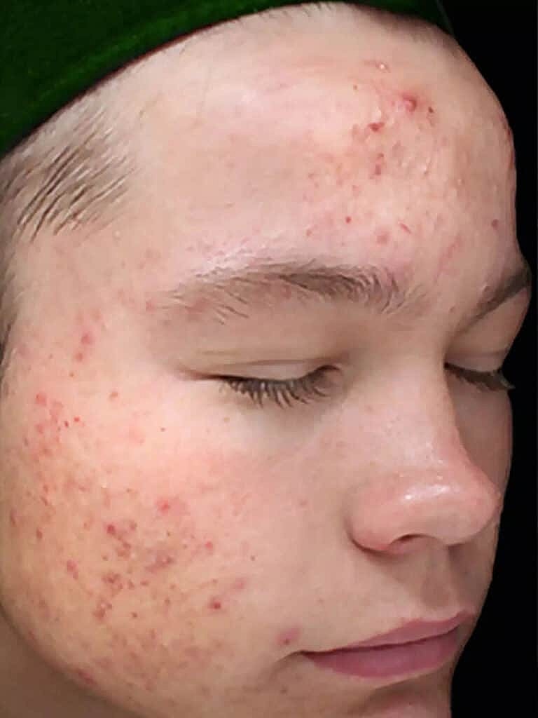 Chemical Peels Before & After