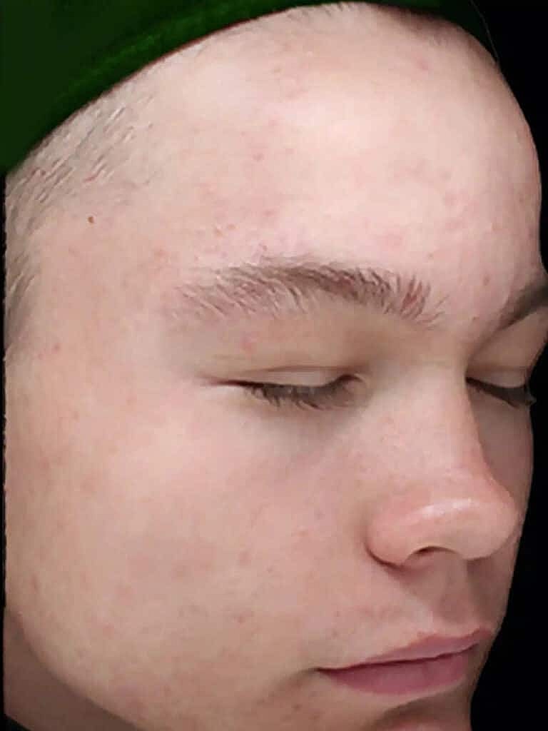 Chemical Peels Before & After