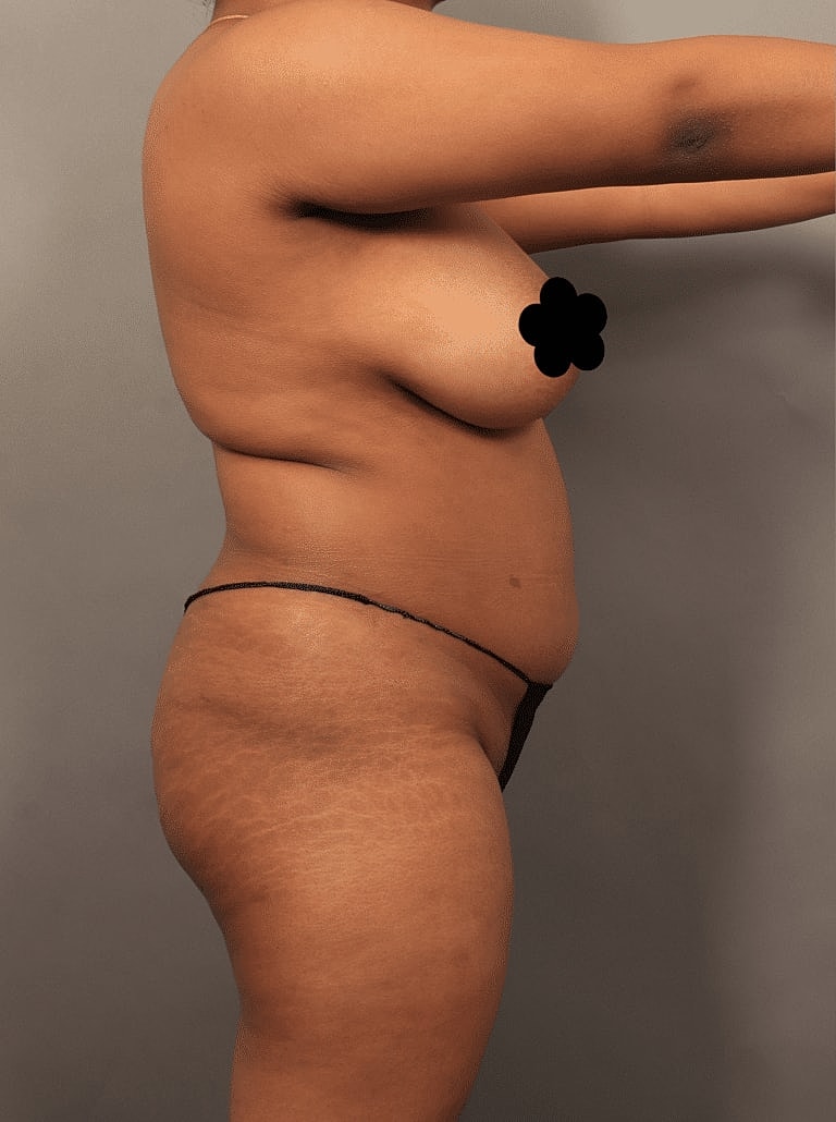 Cosmetic Fat Transfer Before & After