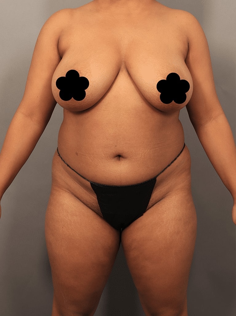 Cosmetic Fat Transfer Before & After