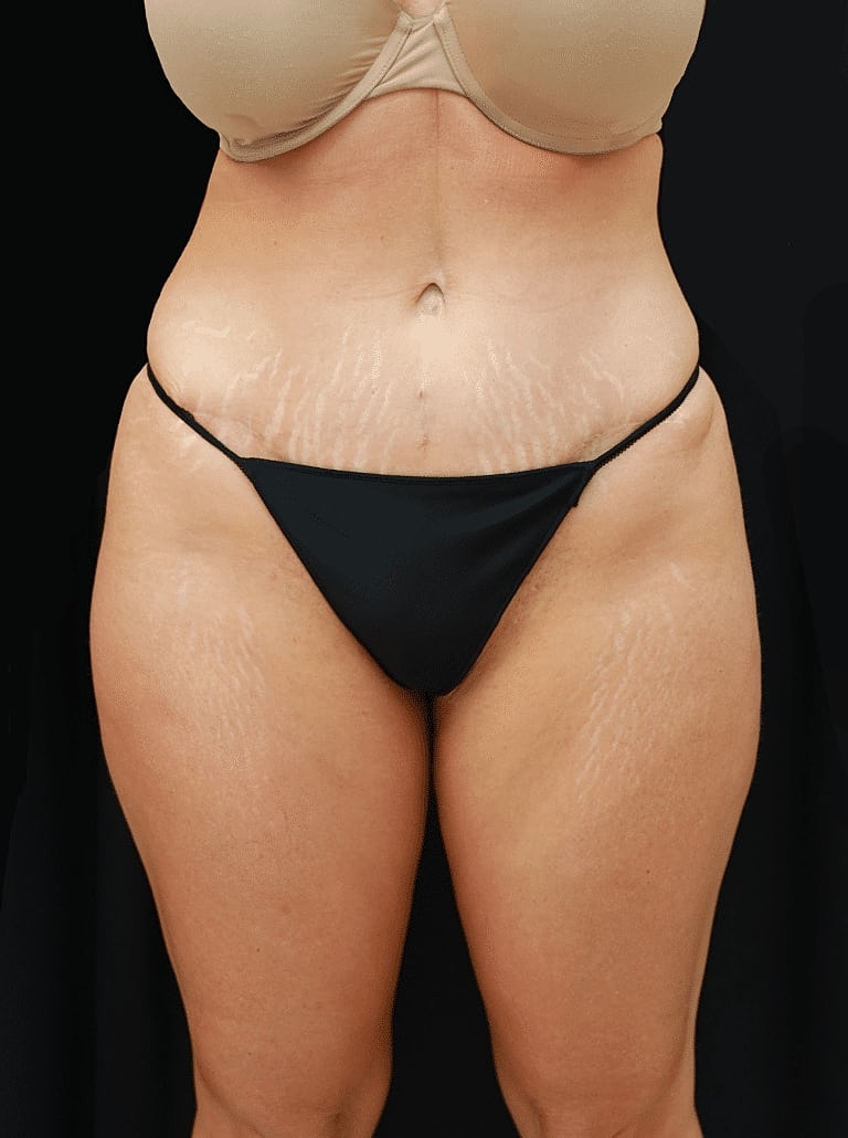 Cosmetic Fat Transfer Before & After