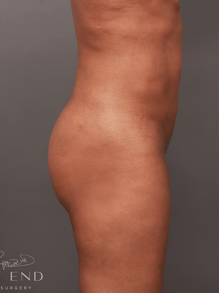 Cosmetic Fat Transfer Before & After