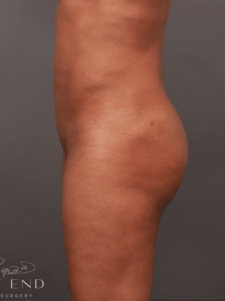 Cosmetic Fat Transfer Before & After