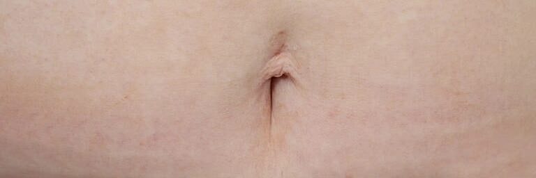 Cosmetic Fat Transfer Before & After