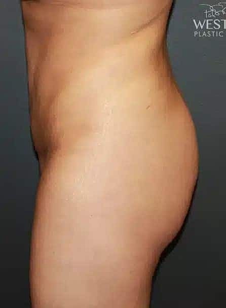 Cosmetic Fat Transfer Before & After