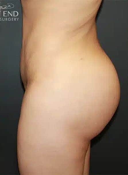 Cosmetic Fat Transfer Before & After