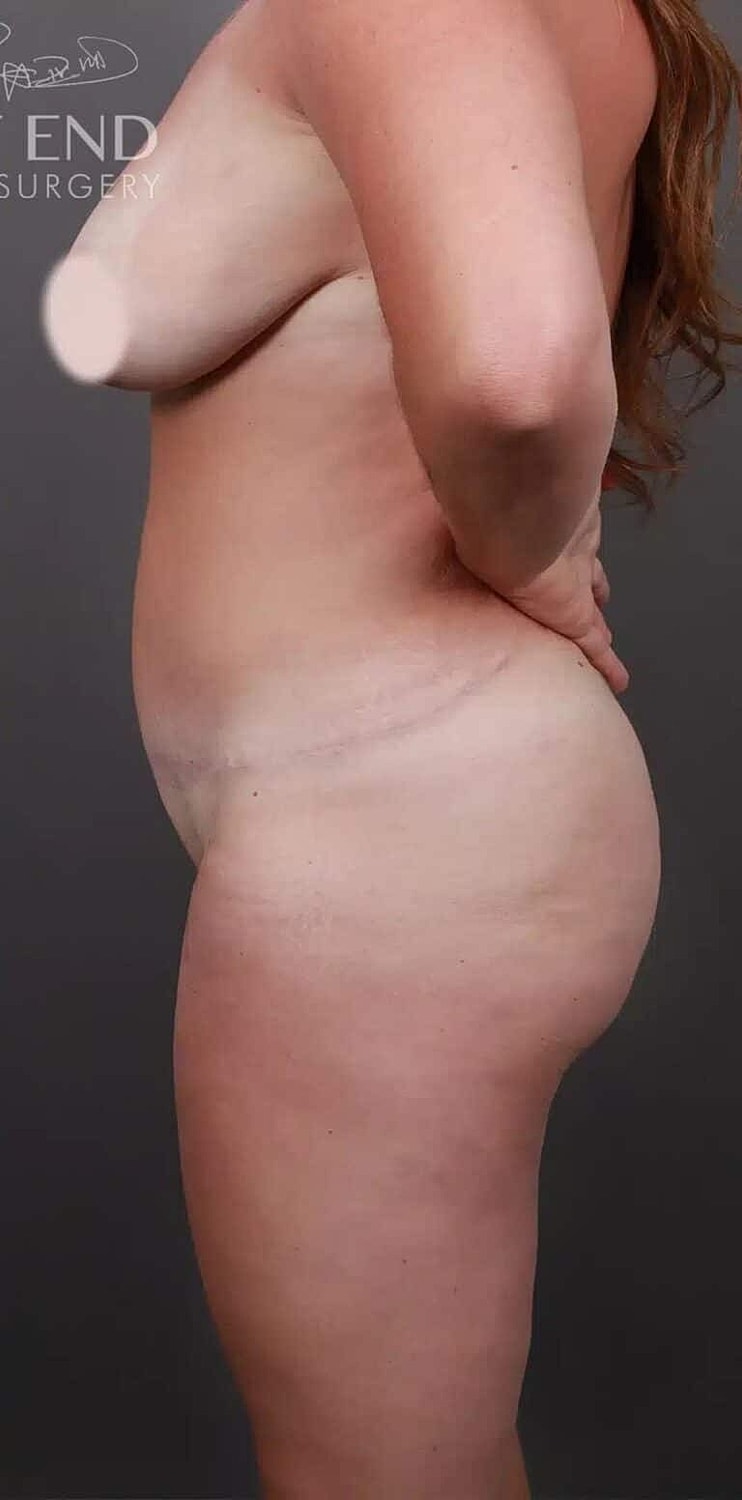 Cosmetic Fat Transfer Before & After