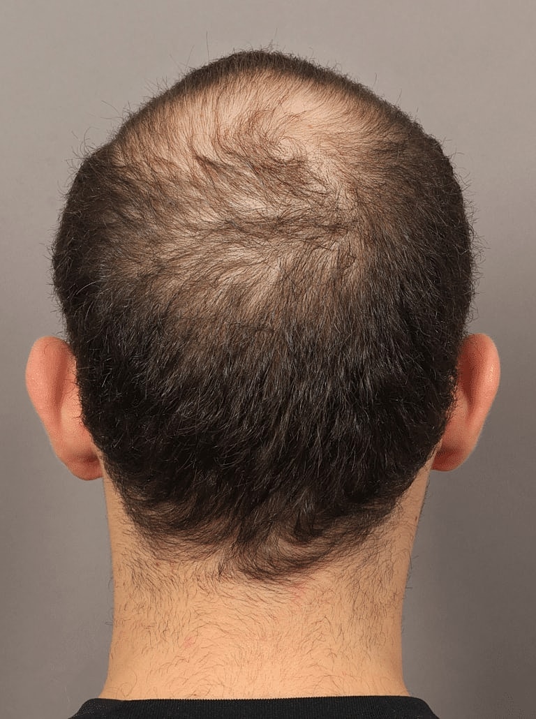 Hair Restoration Before & After