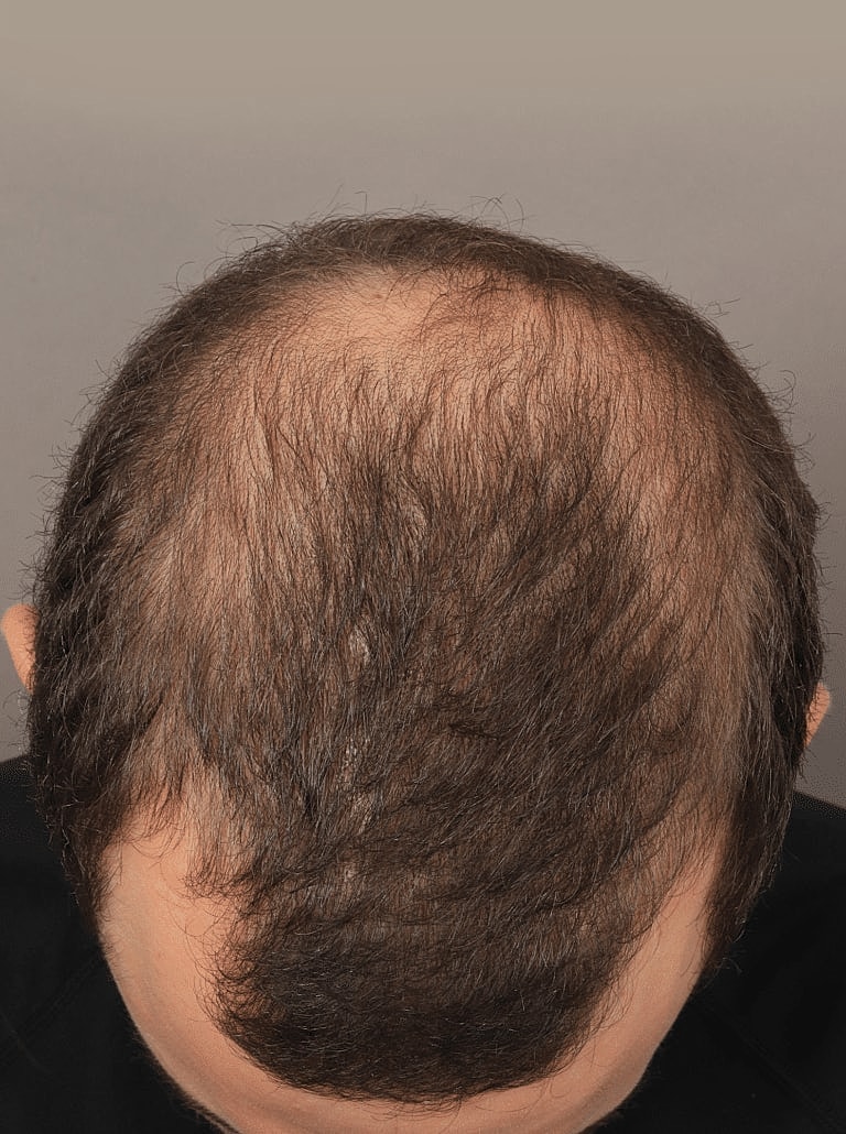 Hair Restoration Before & After