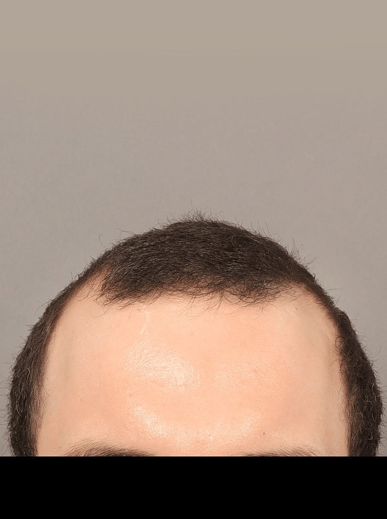 Hair Restoration Before & After