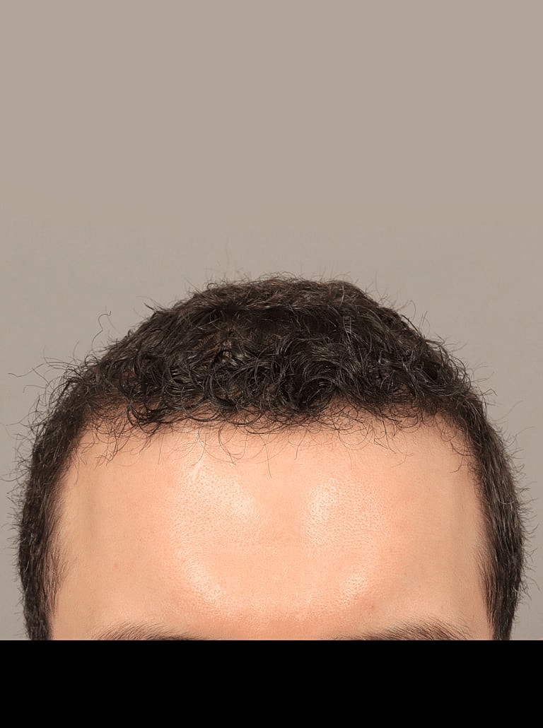 Hair Restoration Before & After