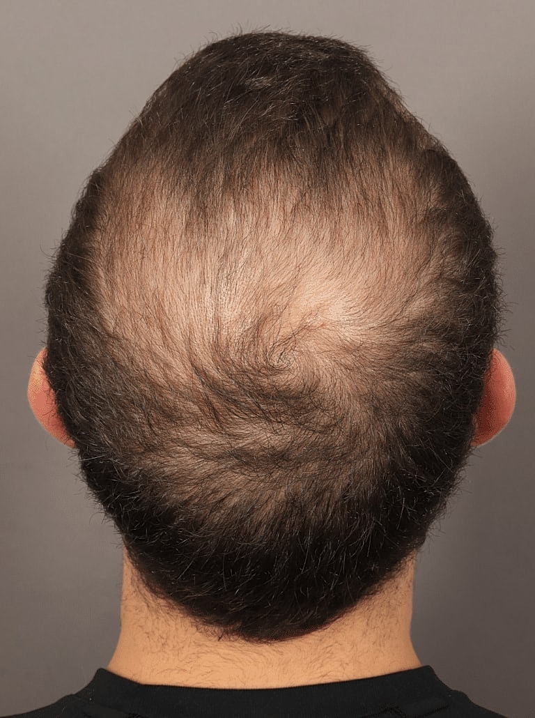 Hair Restoration Before & After