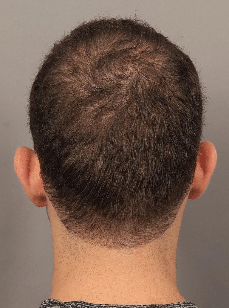 Hair Restoration Before & After