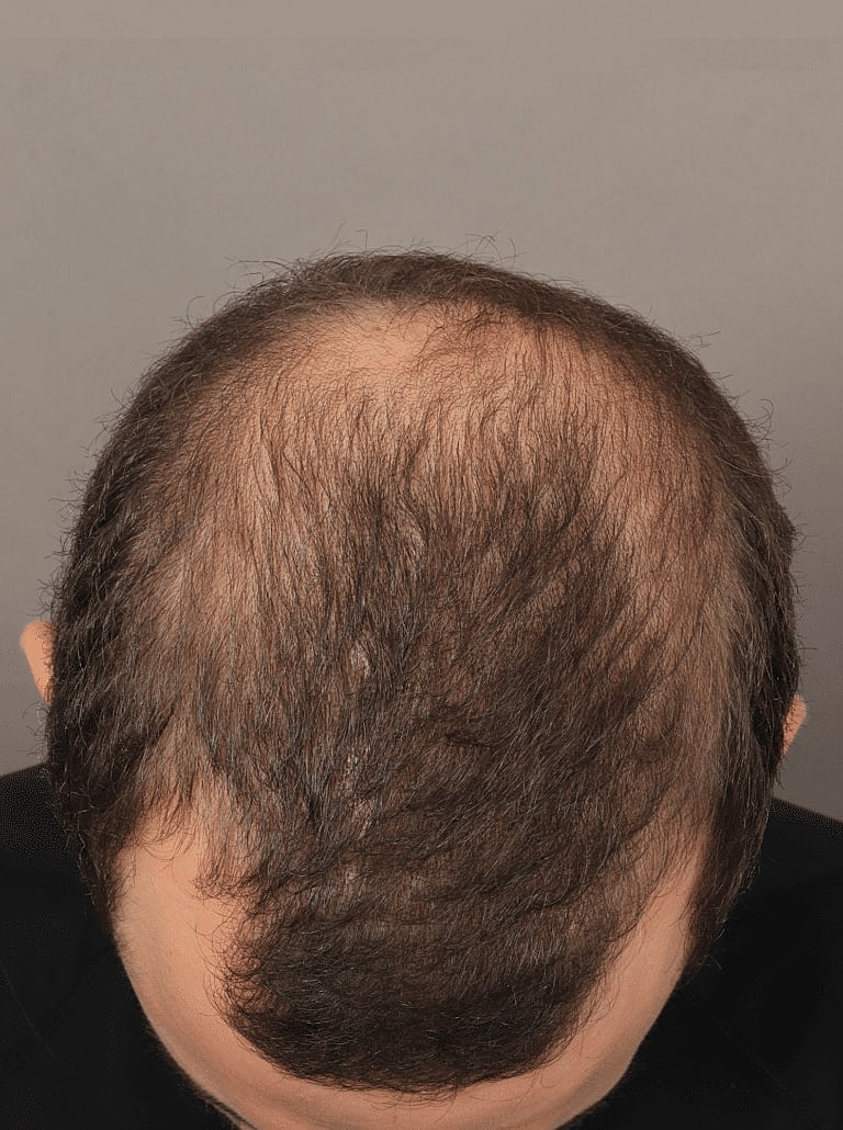 Hair Restoration Before & After