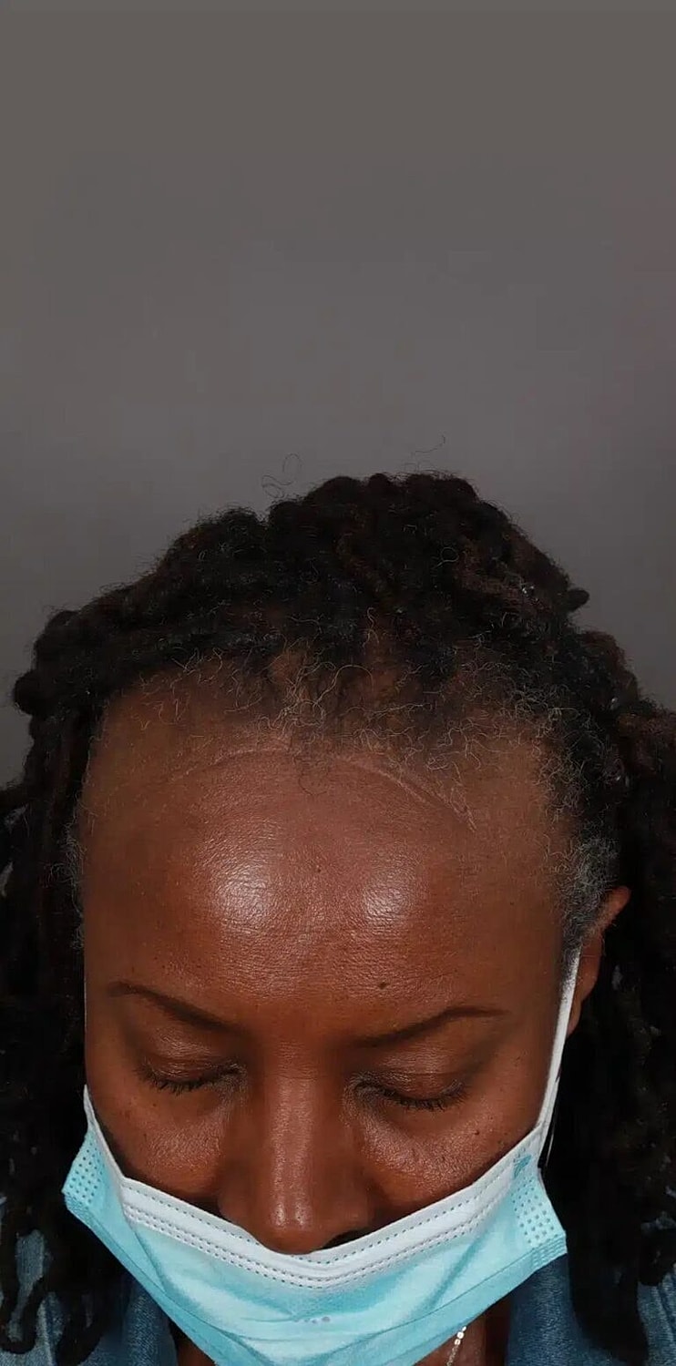 Hair Restoration Before & After