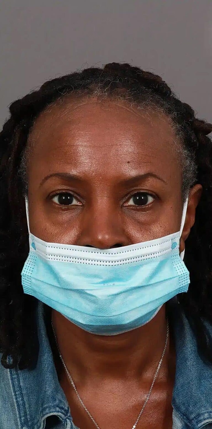 Hair Restoration Before & After