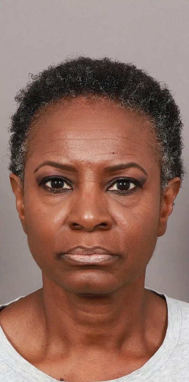 Hair Restoration Before & After