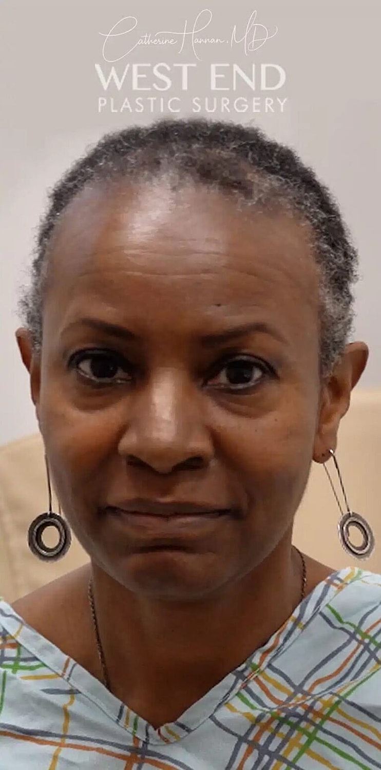 Hair Restoration Before & After