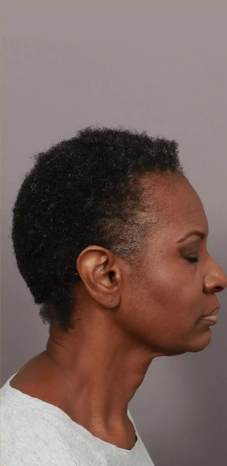 Hair Restoration Before & After