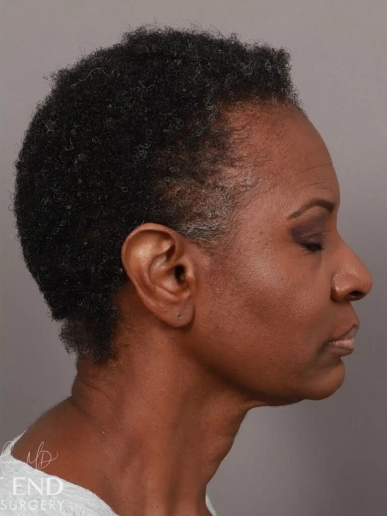 Hair Restoration Before & After