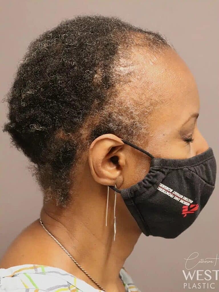 Hair Restoration Before & After