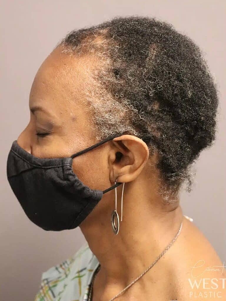 Hair Restoration Before & After